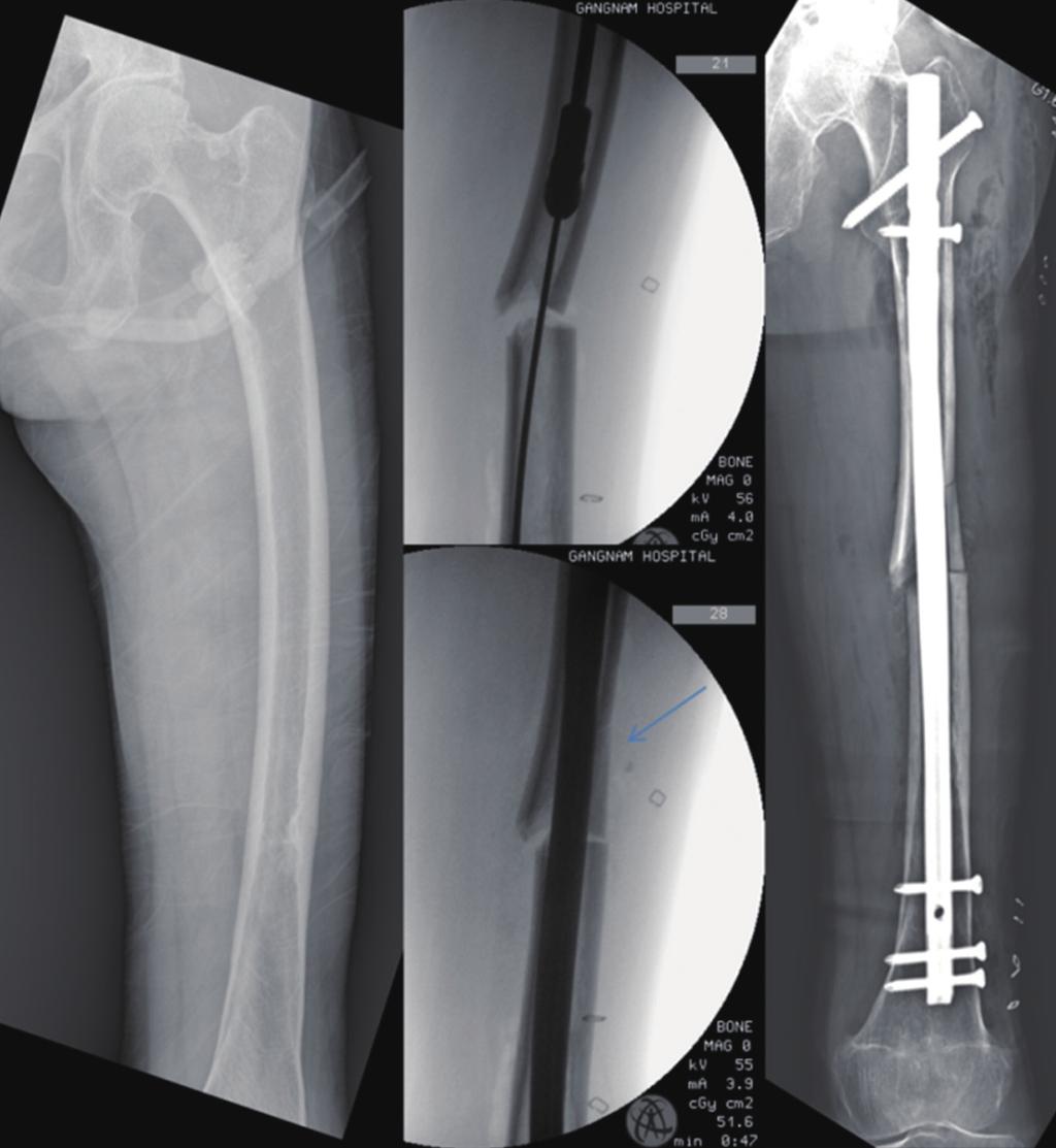 Prophylactic femoral nailing is indicated when the dreaded black line is visible in the lateral femoral cortex, especially in the subtrochanteric area.