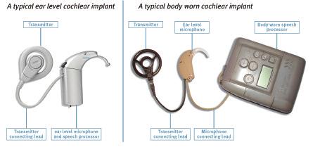 What is a cochlear implant? A cochlear implant system has two parts. One part is worn externally like a hearing aid, the other is surgically implanted internally.