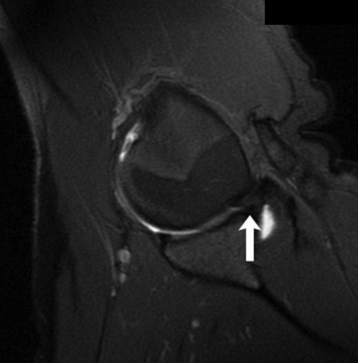 Oblique coronal fast spin-echo T2-weighted MR image shows infraspinatus tendon has increased signal near it insertion on