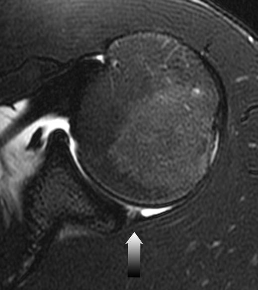 MRI of Internal Impingement of the Shoulder Fig. 5 20-year-old man with abnormal posterior glenoid labrum.