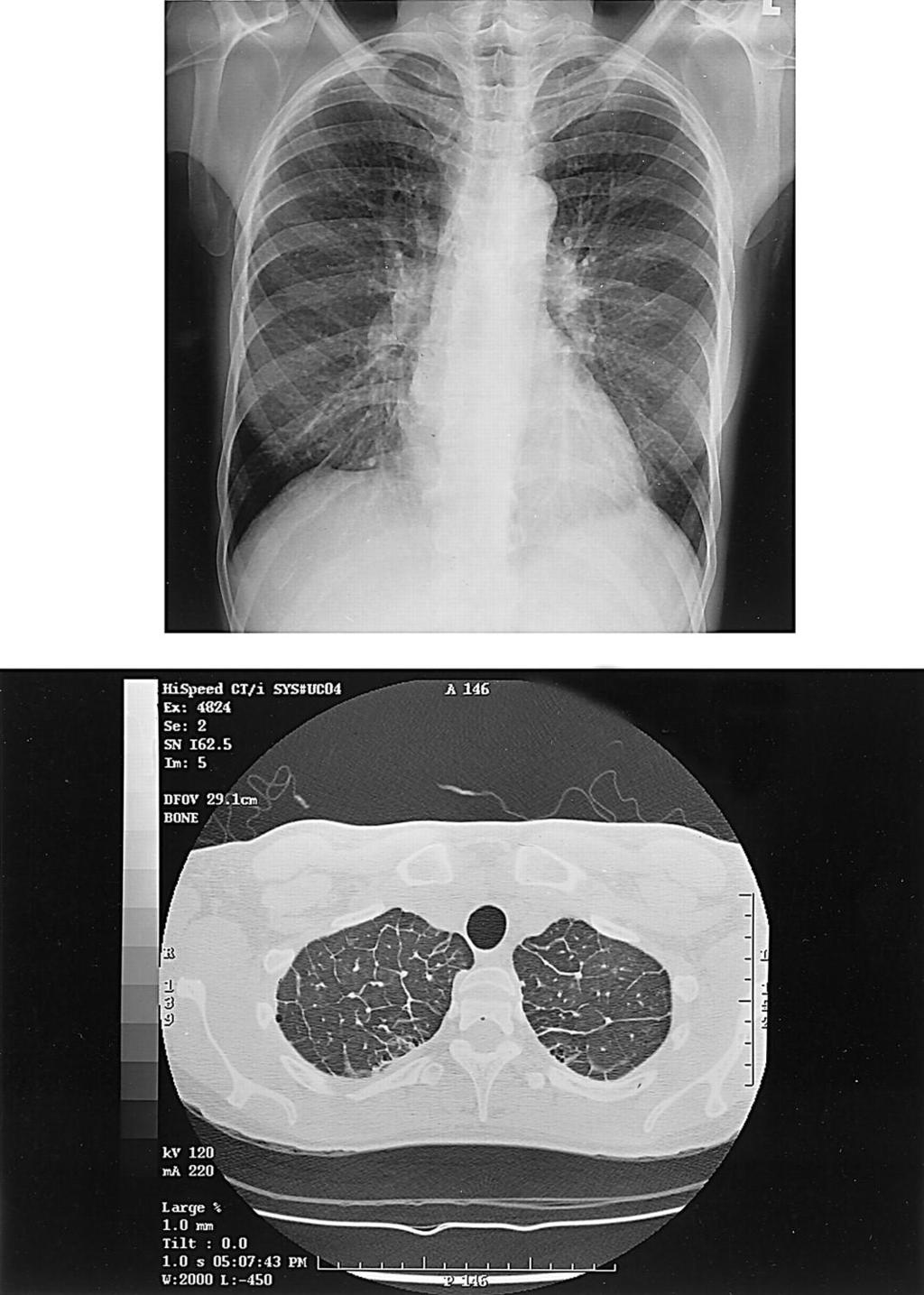 A chest radiograph of a 50-year-old woman with