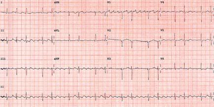 You admit Evelyn to the hospital and successfully rate control her. During her hospital stay, the following ECG is obtained. ECG courtesy of David Kassop, MD FACP FACC What is your diagnosis?