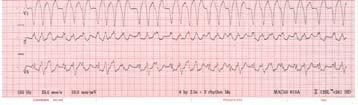 brought has a recurrence of her palpitations and shortness of breath. She goes to the local Emergency Department where a 12- lead ECG is obtained.