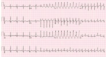 Management of Wide Complex Tachycardia If patient is unstable Synchronized cardioversion If regular and monomorphic Consider adenosine Antiarrhythmic therapy Procainamide Amiodarone Sotalol