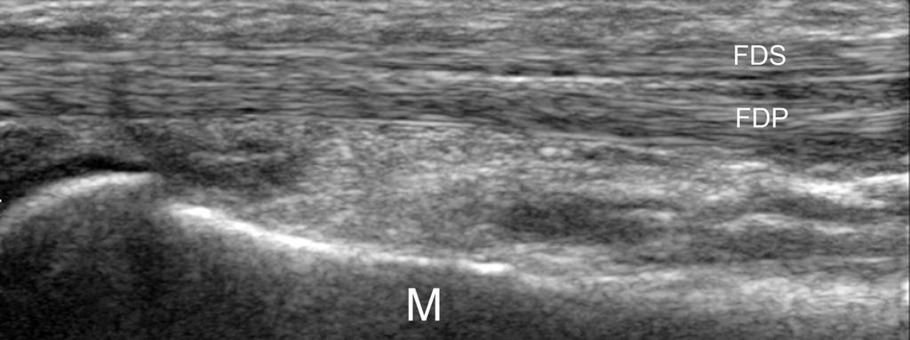 Fig. 7: 7. US longitudinal scan of the third flexor digitorum tendon.