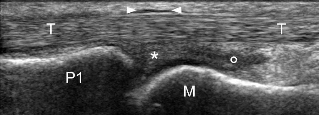 Fig. 9: 9. Longitudinal scan of the metacarpophalangeal joint, palmar side.