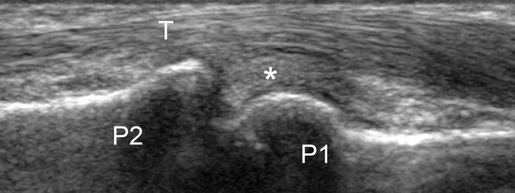 Fig. 11: 11. Proximal interphalangeal joint longitudinal scan, palmar side.