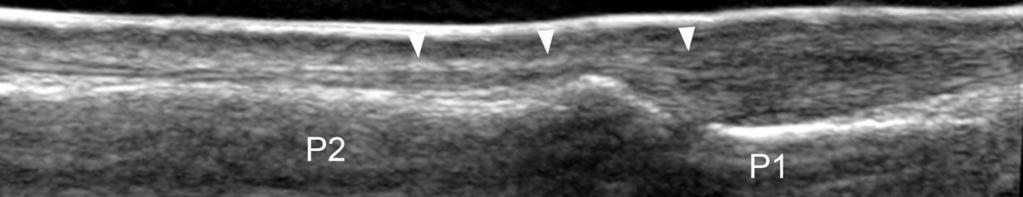 Fig. 19: 19. Proximal interphalangeal joint longitudinal scan, dorsal side.