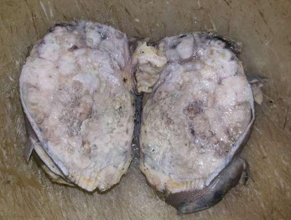 Figure 2- cut surface of tumor showing grey white variegated, fleshy