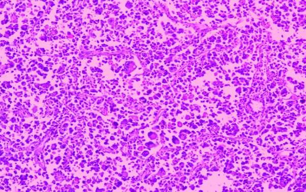 Figure 3- Section shows highly cellular tumor with pleomorphic,