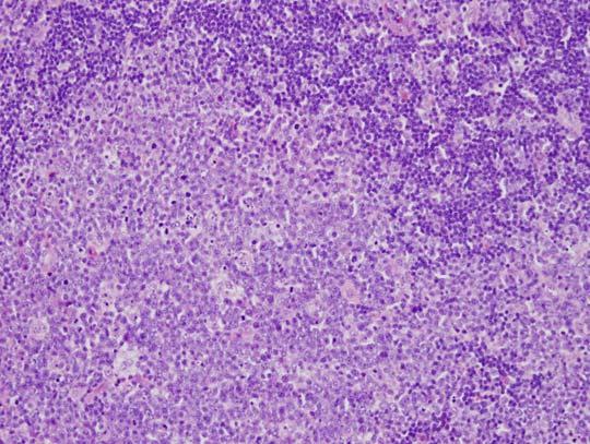 Other Follicular Lymphoma variants typically lacking t(14;18) Pediatric follicular lymphoma Head and neck Males >>> Females t(14;18) positive cases may be