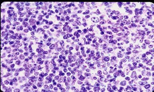 CYTOLOGIC FEATURES Cytologic criteria FCC: Unusual cytologic features Grading of Follicular Lymphoma Differences between grade 3A and grade 3B MEASURING CELL SIZE 1.