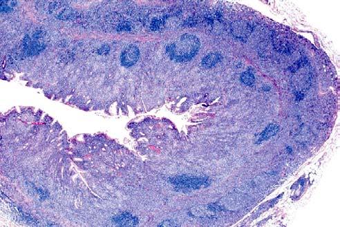 Probability present Marginal zone lymphoma (MZL) Follicular lymphoma with marginal zone B- cell differentiation Small lymphocytic lymphoma