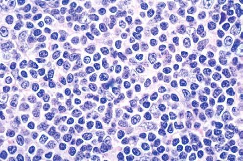 clinically & genetically 3. In addition, primary nodal marginal zone B-cell lymphoma in children & young adults is probably a distinct entity 4.