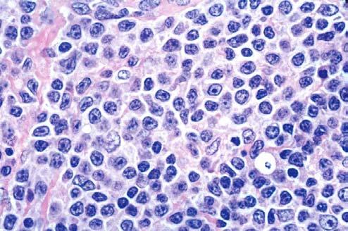 LYMPHOMA OF MALT TYPE (in the left salivary gland) CASE 9 SHOWN TO ILLUSTRATE Current criteria of MALT lymphoma in the salivary gland require: