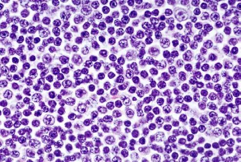 with scanty cytoplasm IAP CASE 12 BNN- 10306 IMMUNOSTAINS RESULTS Both