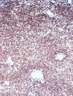 CD20 bcl-2 IAP CASE 10 BNN-13515 DIAGNOSIS MARGINAL ZONE B CELL LYMPHOMA WITH FOLLICULAR