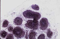 CD20 bcl-2 CD10 bcl-6 FOLLICULAR LYMPHOMA WITH MARGINAL ZONE PATTERN Three-layered follicles (marginal zone pattern) Inner layer of