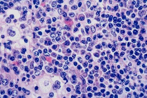 Granulomatosis MORPHOLOGIC VARIANTS OF DLBCL Centroblastic Immunoblastic Plasmablastic