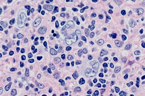 PLASMABLASTIC A rare subtype with distinctive features Oral lesions in HIV+ individuals Large cells with abundant basophilic cytoplasm and paranuclear hof.