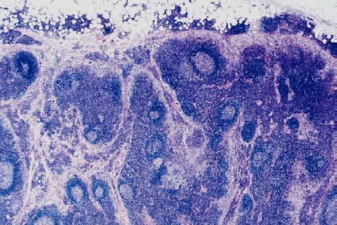 T-CELL & HISTIOCYTE RICH LARGE B-CELL LYMPHOMA: MORPHOLOGIC VARIANTS 1. Lymphocytic & Histiocytic-like: 14 cases 2. Centroblasts or Immunoblasts: : 10 cases 3.