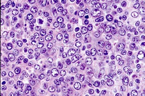 Significance of Marginal Zone B-Cell Differentiation in Follicular Lymphoma CORRELATION OF MORPHOLOGIC FINDINGS WITH TRISOMY 3 AND 3q 27-29 29 TRANSLOCATION ABNORMALITIES INVOLVING CHROMOSOME 3