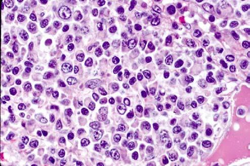 cells in all 3 cases (100%) of follicular lymphomas with marginal zone B- B cell differentiation CONCLUSION: These abnormalities may be responsible for the development of the marginal zone B- B cell