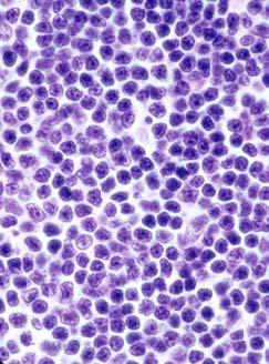 .tion) FL with memory B-cells B in interfollicular area FL with Diffuse Large B-Cell B Lymphoma Quantifying follicularity: : >75%, 75-25%, <25% Follicular &