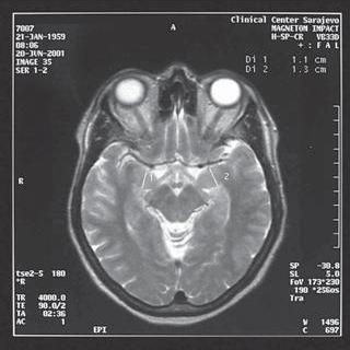 Bilateral injury of the temporal lobe that has a great effect on amygdaloidal complex that causes a series of behavioral changes named Kluver Bucy syndrome.
