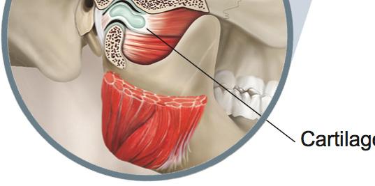 Figure 1 The temporomandibular joint Cartilage disc About this document Your surgeon has recommended open TMJ surgery. However, it is your decision to go ahead with the operation or not.