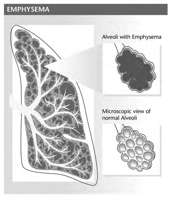 Lungs with Emphysema Emphysema affects the small airways (bronchioles) and the air sacs. The airways and air sacs become damaged and lose their elasticity.