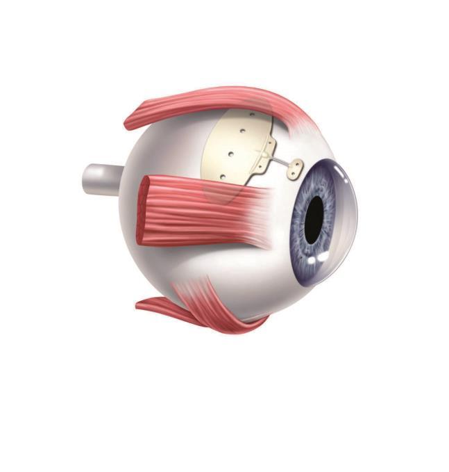 What is a glaucoma drainage tube operation?