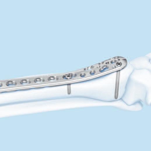 Screw Insertion 5 Insert distal screws Determine the combination of screws to be used for fixation.