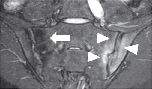 MRI of the sacro-iliac (SI) joints has become a key-imaging technique for the detection of early non-radiographic axial Sp and has been shown to contribute to optimized clinical decisionmaking (3).