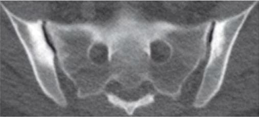T1-weighted SE image of the SI joints shows ankylosis (arrows) with preserved joint space in a 70-yo man with Forestier s disease.