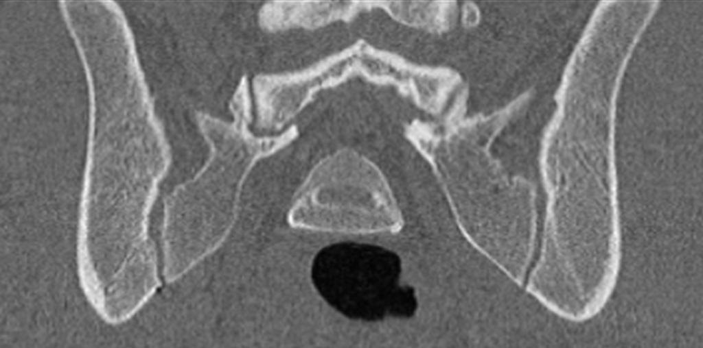 Coronal reformat of a CT of the sacroiliac joints showing gas