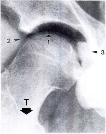 Pathophysiology of Intra- Articular Gas Presence of gas within a joint may be related to the vacuum phenomenon.