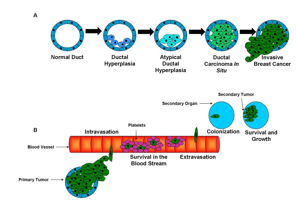Figure 1-1: Progression of Breast Cancer: From Normal Breast to Metastatic Disease. A) A schematic of the Wellings-Jensen model of breast cancer progression.