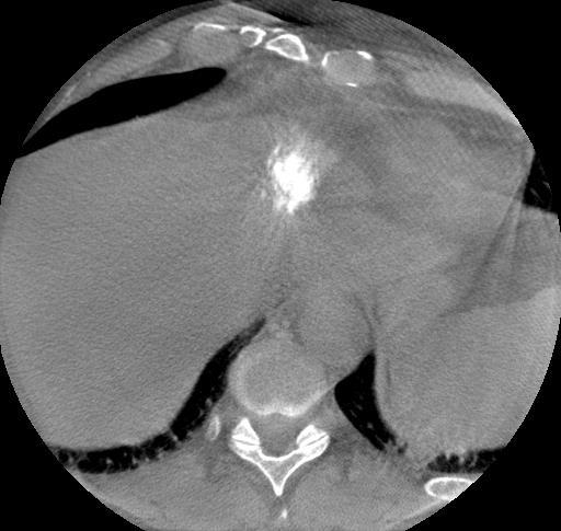 ANGIOGRAPHY Axial Cone