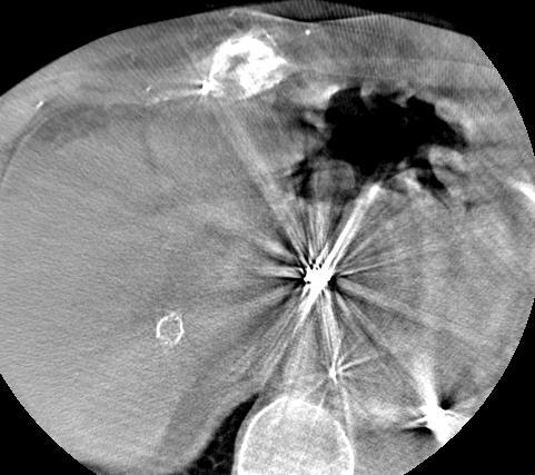 Gut. 2009;58:734 735. 5. Snoeren, N., Jansen, M.C., Rijken, A.M. et al, Assessment of viable tumour tissue attached to needle applicators after local ablation of liver tumours. Dig Surg.