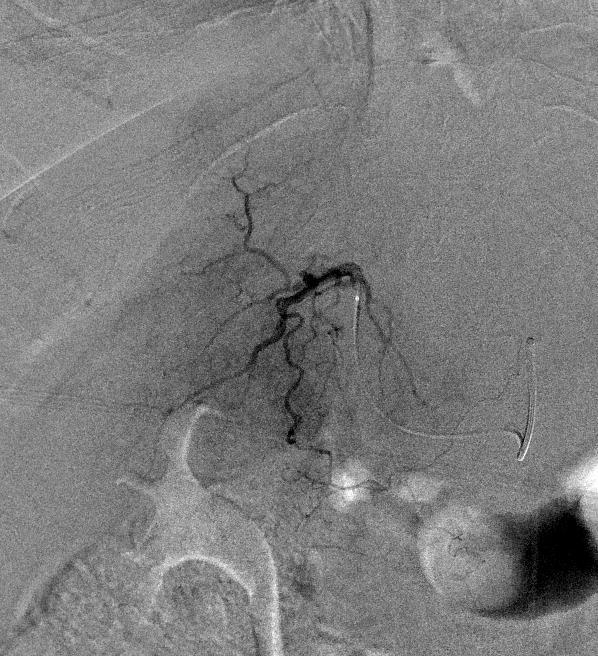 Angiogram Middle