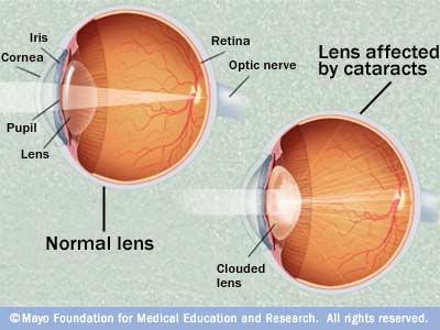 Cataract Patient Information 1. Within the human eye, there is a normal structure called the lens.