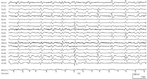 EEG in SSPE Creutzfeldt-Jakob disease (CJD) Transmittable disease from Prion protein Spongioform encephalopathy Clinical Rapidly progressive dementia myoclonus