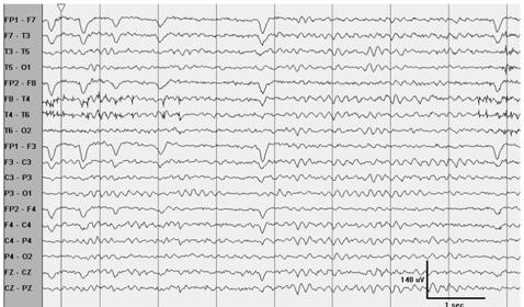 Common EEG patterns Background slowing: mild severity