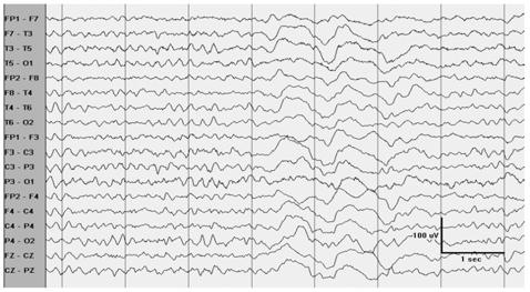 intermittent rhythmic delta activity OIRDA Occipital