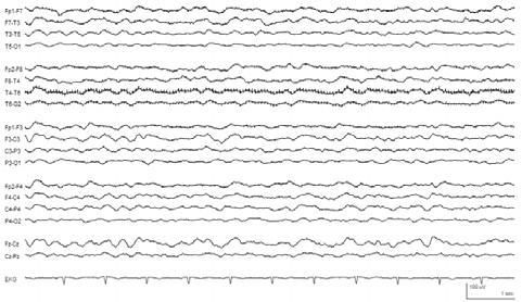 Periodic patterns Burst-suppression pattern Electrocerebral