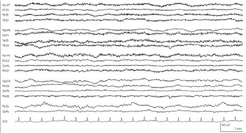 reactivity Nearly flat EEG Electrocerebral