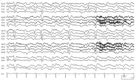 Triphasic waves Grade Severity assessment Characteristics Grade I Grade II Grade III Grade IV Grade V Dominant activity is alpha rhythm with minimal theta activity Dominant theta background with
