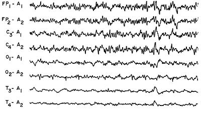 electrocerebral inactivity Toxic encephalopathy Sedative-hypnotic agents overdose EEG in specific encephalopathies Pathognomonic Excessive beta activity over anterior head regions More severe:
