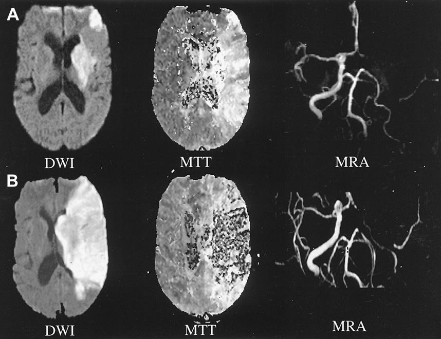 204 Kelley & Martin-Schild EVALUATION AND TREATMENT OF CEREBRAL EDEMA ASSOCIATED WITH ISCHEMIC STROKE There are several potential explanations for deteriorating stroke manifestations in patients who